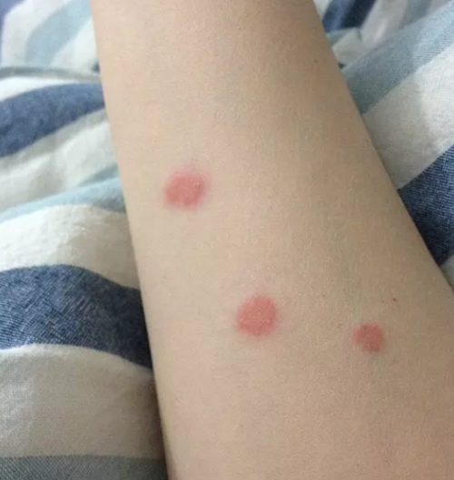 猫癣会不会传染给人? 会,虽然有传染性,但与癣接触不总是会被感染到.