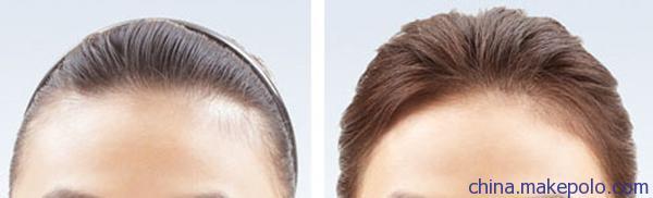 男女发际线调整修复 发际线后移修补 生物头皮无痕补发技术
