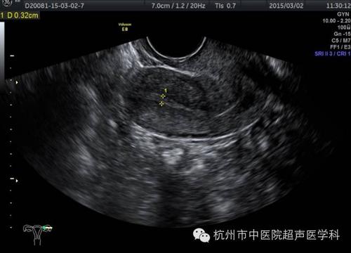 子宫畸形的超声诊断