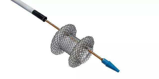 胰腺假性囊肿:超声内镜下支架植入引流操作