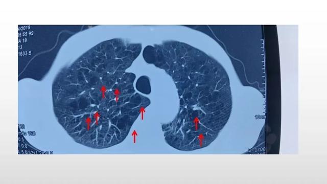 一图看懂什么是肺气肿