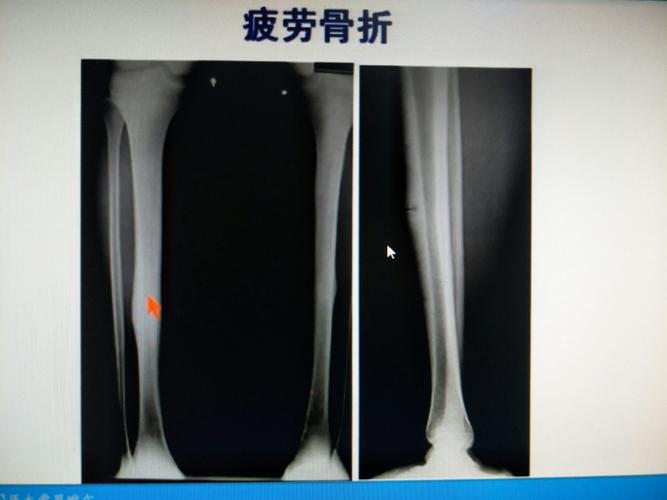 骨折的x线诊断