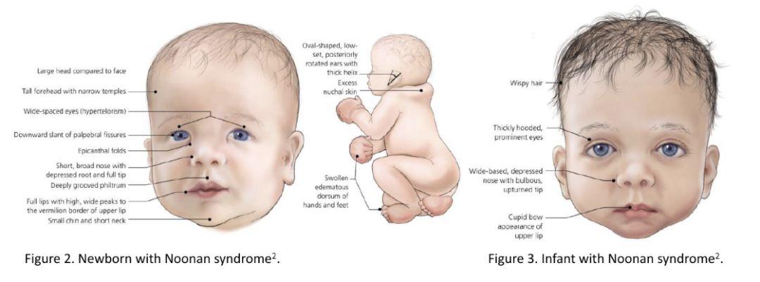 诊断标准:努南综合征的诊断需要通过临床表现和基因检测明确.