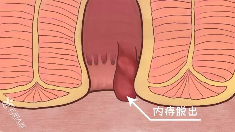 为什么有的痔疮疼有的不疼