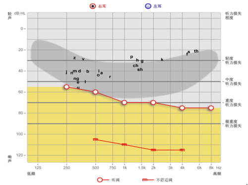 通过听力损失模拟器(上图)我们可以看到刘先生因为听力曲线整体都在