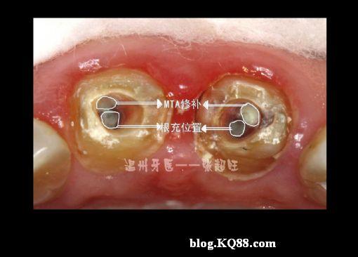 根管侧穿mta修补后再修复张超旺