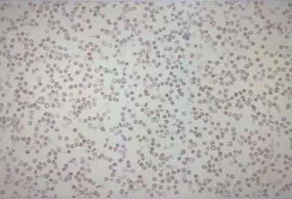 一例假性增高的血小板计数,快来看看!