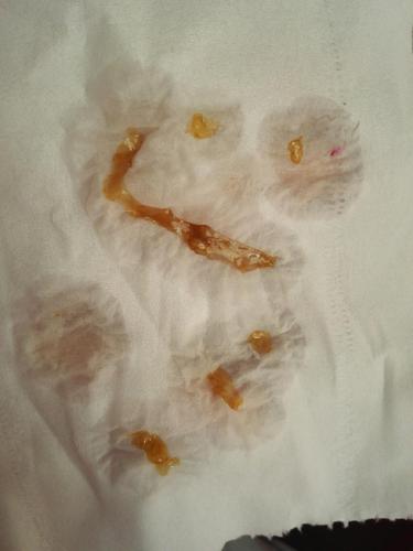 这是分泌物,还是破羊水呀(图片可能会给您带来不适,慎入)