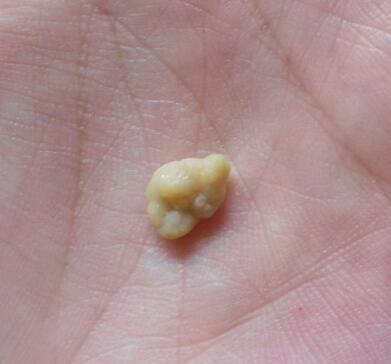 喉咙里有白色颗粒,很臭,这是怎么回事?