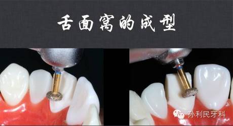 舌面窝的预备是大家很容易忽略的地方.