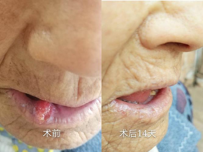 华宁县人民医院皮肤科手术治疗"唇部皮肤高分化鳞状细胞癌患者一例"