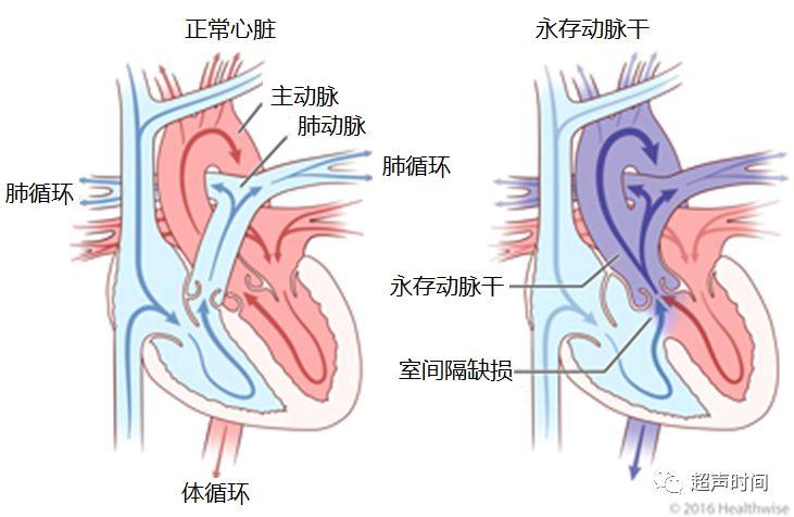「钰」您谈心:胎儿永存动脉干畸形