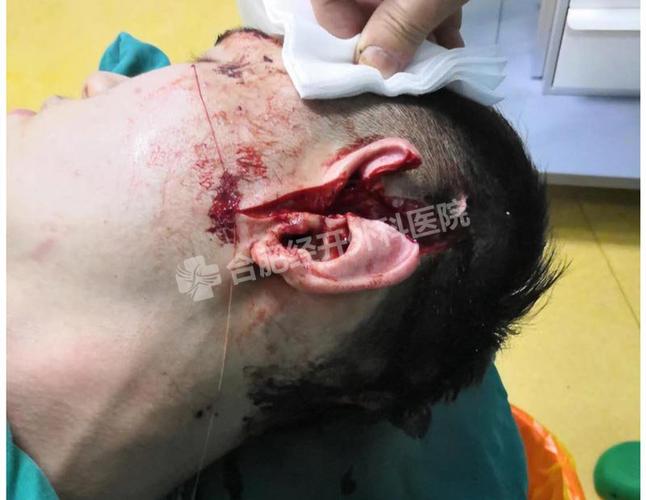 王先生今年17岁,因工作时不慎被机器切割致头部导致外伤伴耳廓撕裂伤