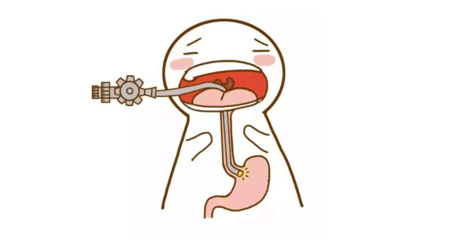 无痛胃镜真的无痛吗?那是怎样的一种体验?