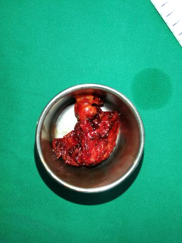 血管里面的玉石