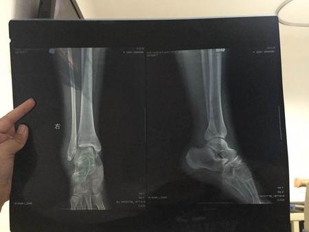 这周一脚踝骨折了,上了夹板,外敷药物治疗,现在第六天了,只要一下床脚