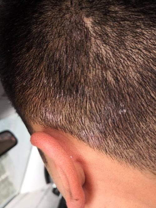 想问问大神我这是什么头皮癣 有点痒头皮屑多 大多是大片头皮屑