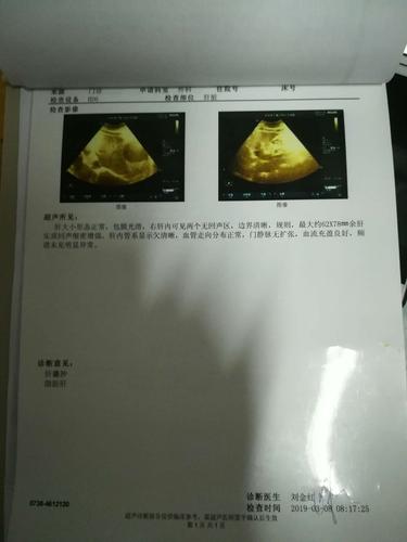 彩超提示肝囊肿.