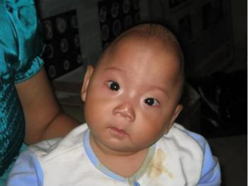 小颅:多为小儿颅缝早闭所致,主要表现为头颅顶部尖突高起,额部窄小,而