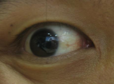 [传染科]眼睛黄是跟乙肝有关吗?有照片