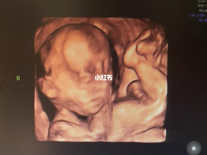 双胞胎四维彩超的照片,感觉没那么丑_双胞胎_四维彩超