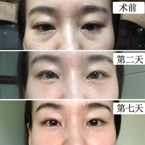 内切眼袋眶隔脂肪释放一周反馈
