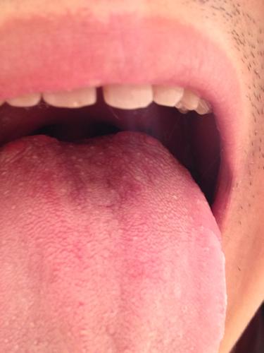 舌头根部有红色得小疙瘩,不痛不痒,用手摸