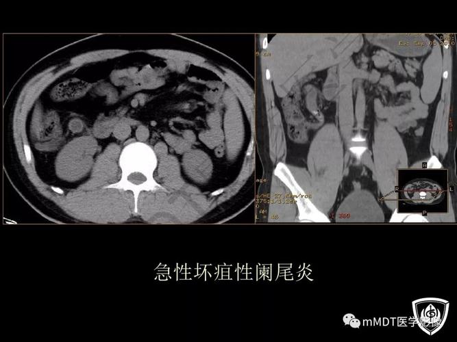 ppt急性阑尾炎的ct诊断