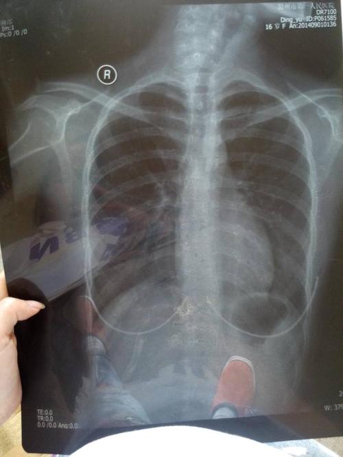 胸透能看出骨骼发育吗?