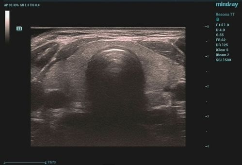 超声入门正常甲状腺超声表现