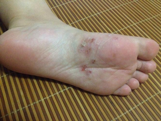 脚藓皮肤病图片