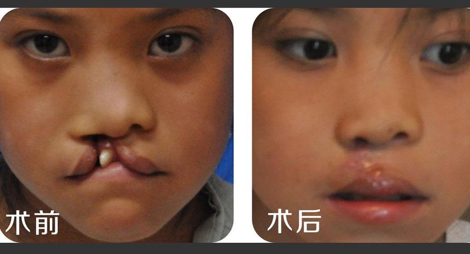 唇裂修复术效果如何?