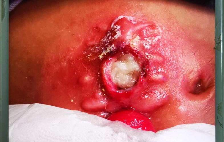 肛周反复溃口可能是克罗恩病