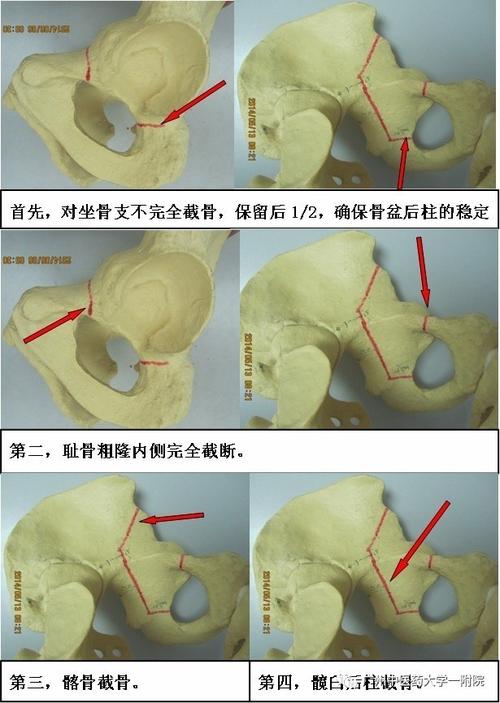 手术入路常用改良smith-peterson入路,术中对髂骨,坐骨支,耻骨支截骨