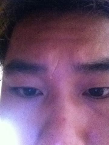 我额头有一条疤痕缝了三针是四年前的,要怎