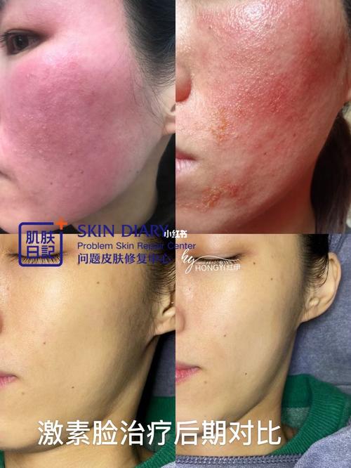 真实案例|激素脸为什么一定要排毒?_排毒_护肤_医疗健康_医疗健康其他