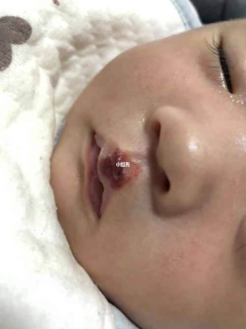 宝宝生出来一个星期嘴上就长了个血管瘤 图一是20多天