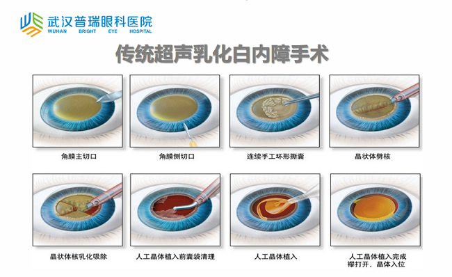 湖北广播电视台邦华导医燕涛专访了解白内障手术