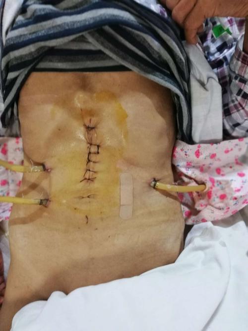 手术室,icu科配合下顺利 独立完成我院首例腹腔镜下胃癌