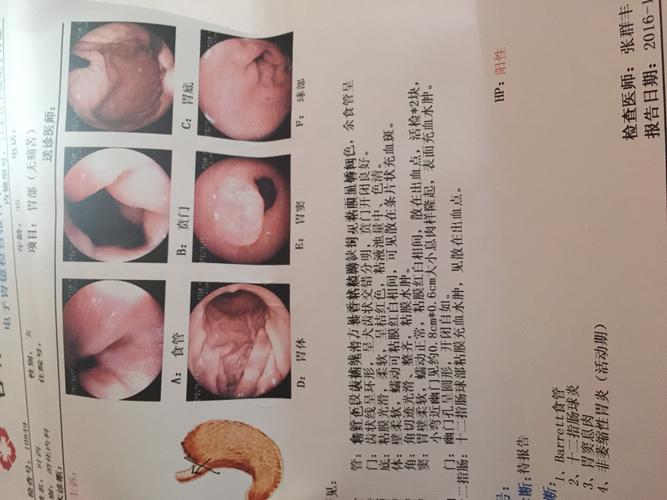 胃部泛酸恶心隐约胃痛