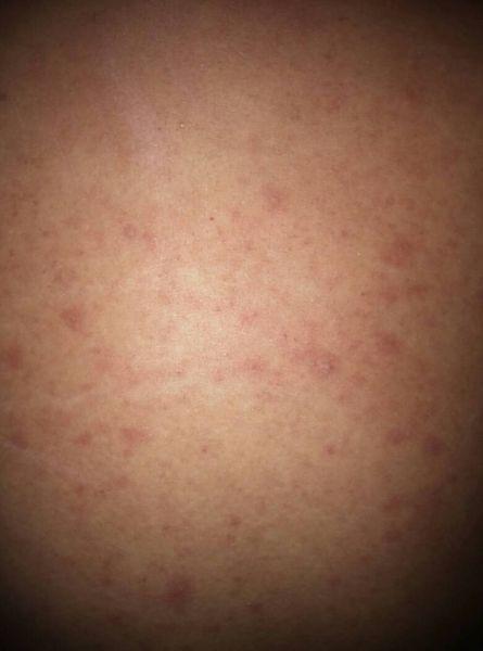 问:背部 大面积红疹 有时有瘙痒感