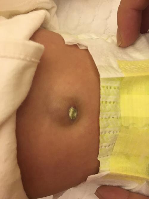 肚脐眼多久能好,这样凸起正常吗?_百度宝宝知道