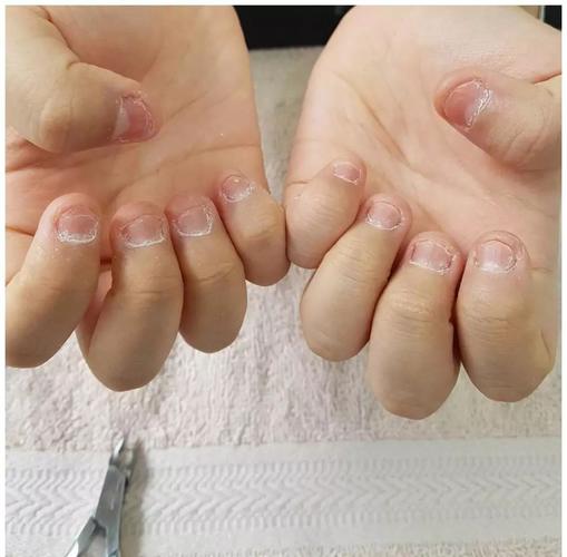 啃指甲,咬指甲的后果居然是这样的.