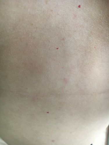 最近身上涨了很多这种小红点点,不痛不痒?