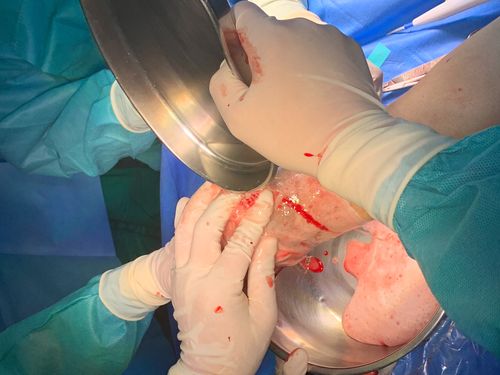 双氧水,盐水冲洗伤口,止血,备皮,更换器械敷料,准备植皮