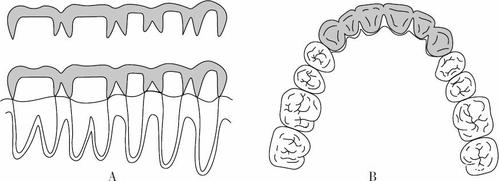 牙周病的修复治疗之牙弓夹板固定