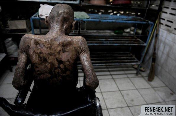 女性艾滋病人初期症状,艾滋病人死亡图片,女性艾滋病人初期症状