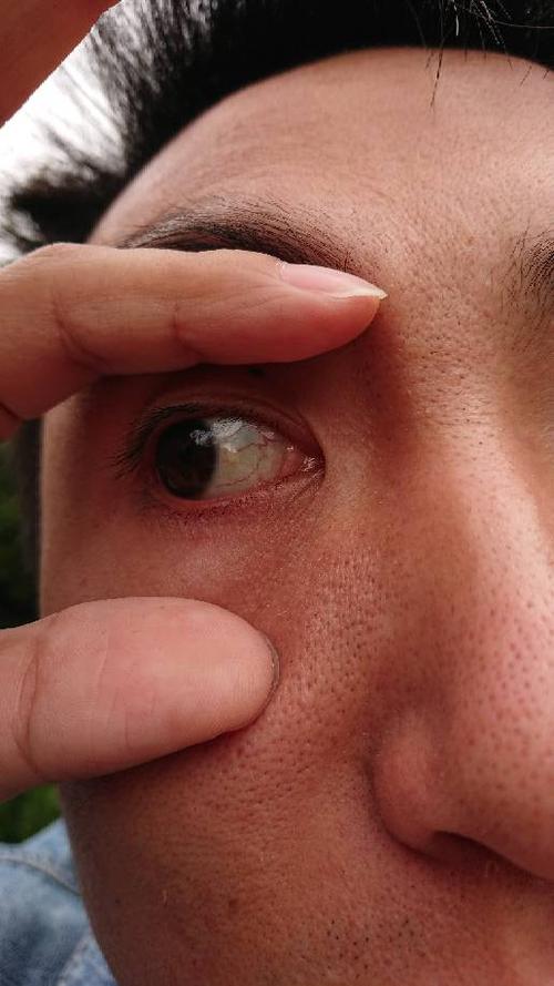 眼睛里有个痘痘