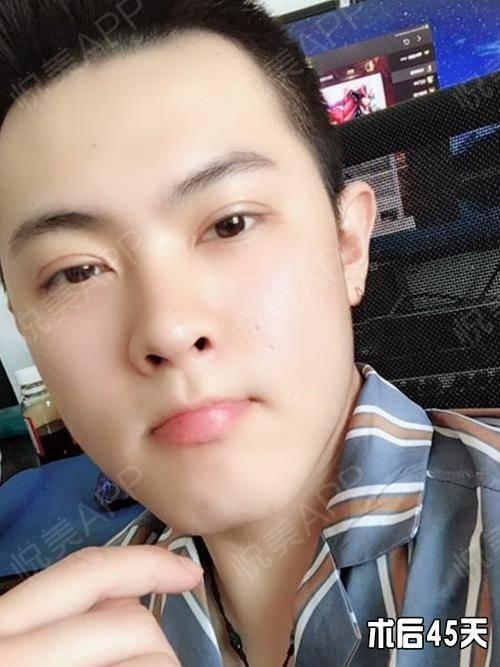 男生做了双眼皮简直帅炸了