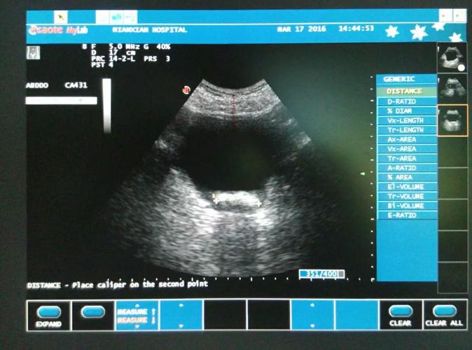 此外,由于结石可能会造成尿路梗阻,超声检查还能够帮助我们了解结石